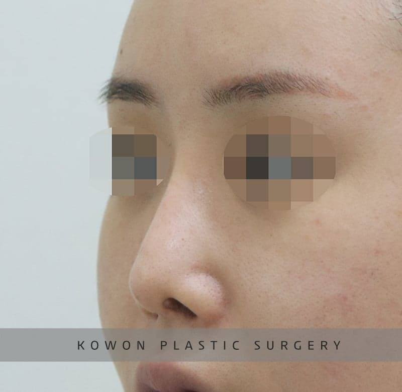 코끝 처짐이 반복된 코, 자가늑연골 재수술로 계획한 이유 — 실리콘 교체와 귀연골 보강까지 관련 이미지 7/9