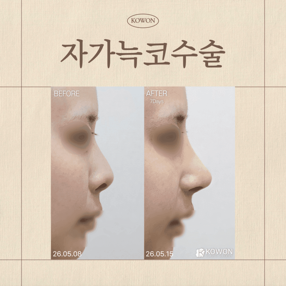 ข้อดีและข้อเสียของการผ่าตัดจมูก กระดูกอ่อนซี่โครงของตนเอง— RIBFIT™ อะไรทำให้ RIBFIT™แตกต่าง? ภาพที่เกี่ยวข้อง 1/2