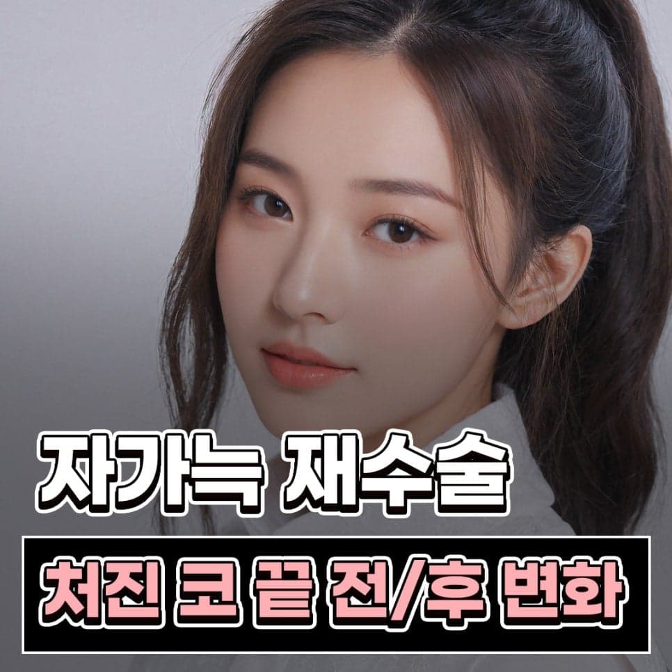 자가늑 코성형, 코끝 처짐은 왜 높이보다 지지 구조를 먼저 보나 관련 이미지 1/9