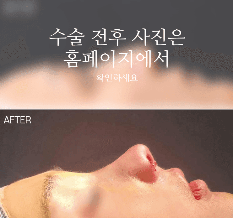 자가늑 코성형, 코끝 처짐은 왜 높이보다 지지 구조를 먼저 보나 관련 이미지 2/9