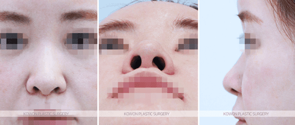 자가늑 코성형, 코끝 처짐은 왜 높이보다 지지 구조를 먼저 보나 관련 이미지 4/9