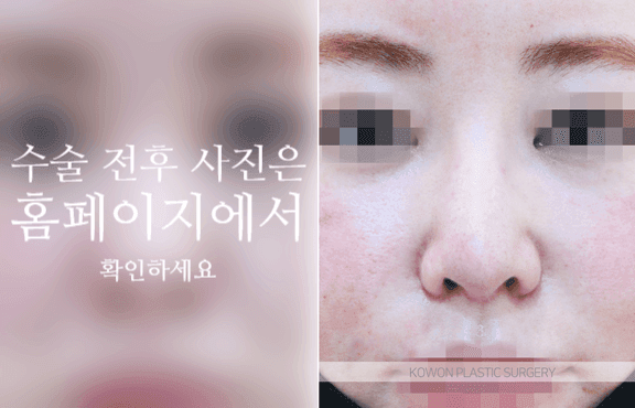 자가늑 코성형, 코끝 처짐은 왜 높이보다 지지 구조를 먼저 보나 관련 이미지 5/9