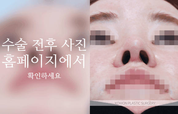 자가늑 코성형, 코끝 처짐은 왜 높이보다 지지 구조를 먼저 보나 관련 이미지 6/9