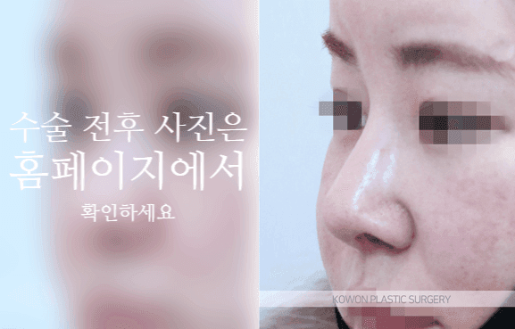 자가늑 코성형, 코끝 처짐은 왜 높이보다 지지 구조를 먼저 보나 관련 이미지 7/9