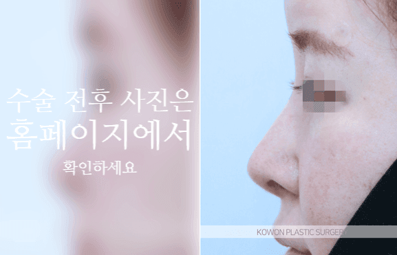 자가늑 코성형, 코끝 처짐은 왜 높이보다 지지 구조를 먼저 보나 관련 이미지 8/9