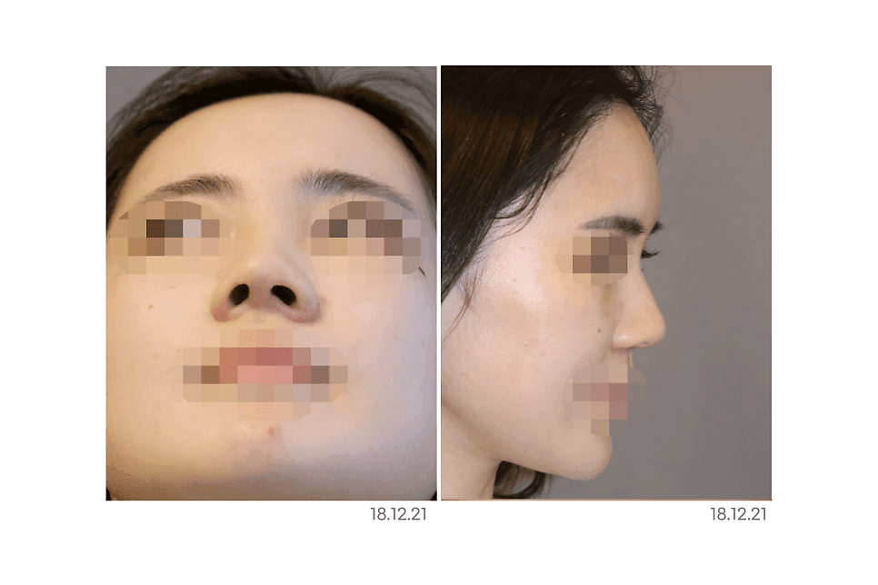 반버선코, 누구에게나 어울릴까 — 얼굴 구조 확인과 자가늑연골 RIBFIT™ 리브핏을 고려하는 이유 관련 이미지 2/6