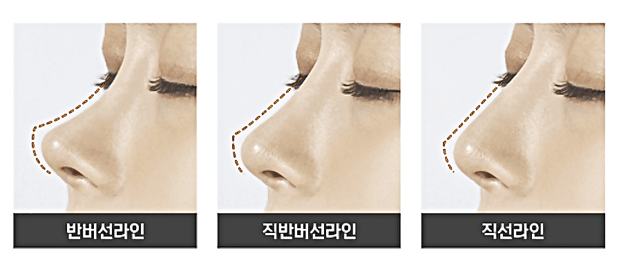 반버선코, 누구에게나 어울릴까 — 얼굴 구조 확인과 자가늑연골 RIBFIT™ 리브핏을 고려하는 이유 관련 이미지 3/6