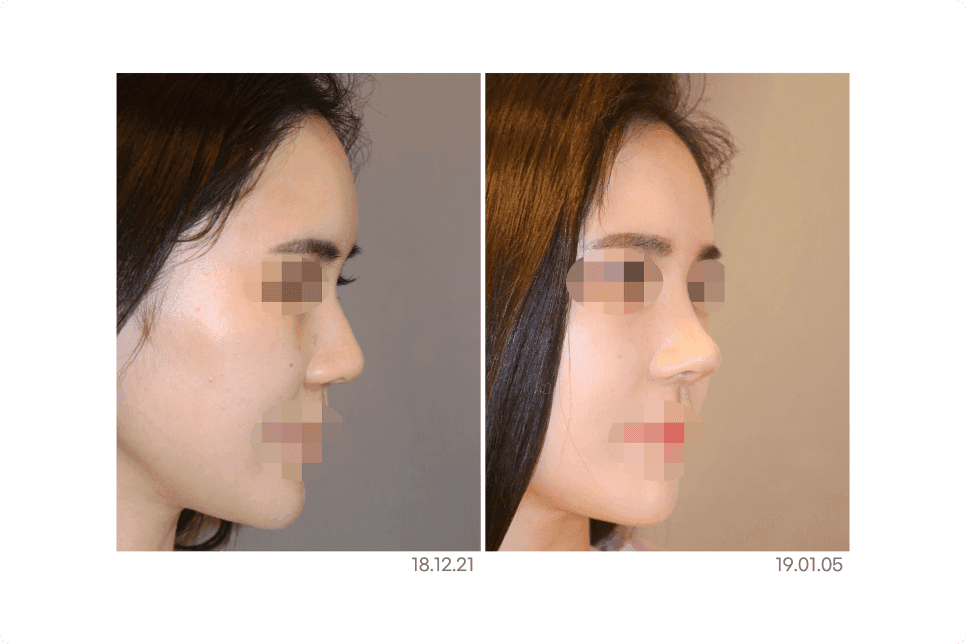 반버선코, 누구에게나 어울릴까 — 얼굴 구조 확인과 자가늑연골 RIBFIT™ 리브핏을 고려하는 이유 관련 이미지 4/6
