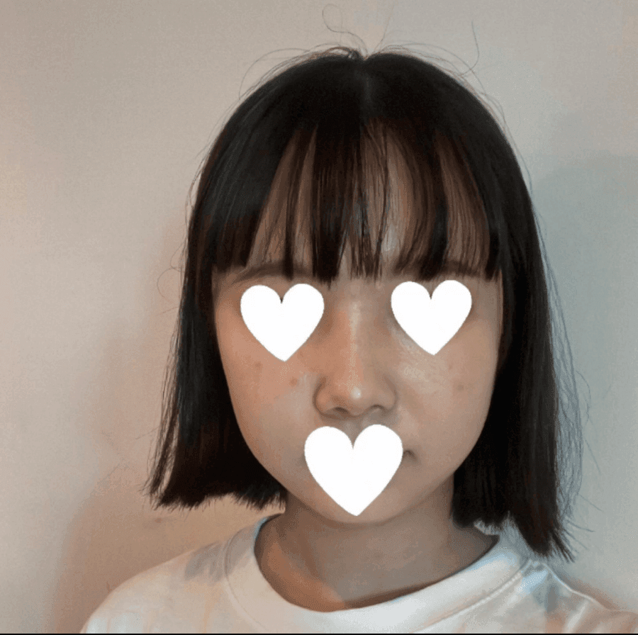 작고 뭉뚝한 코, 비중격만곡증까지 있다면 — 기능코수술을 함께 계획한 사례 관련 이미지 1/17