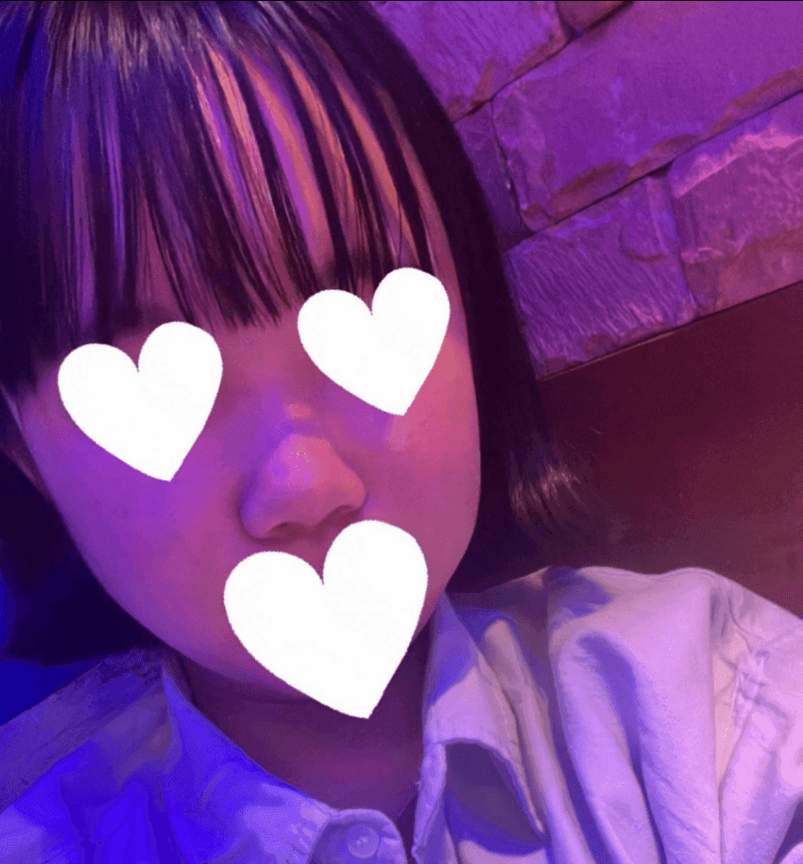 작고 뭉뚝한 코, 비중격만곡증까지 있다면 — 기능코수술을 함께 계획한 사례 관련 이미지 2/17