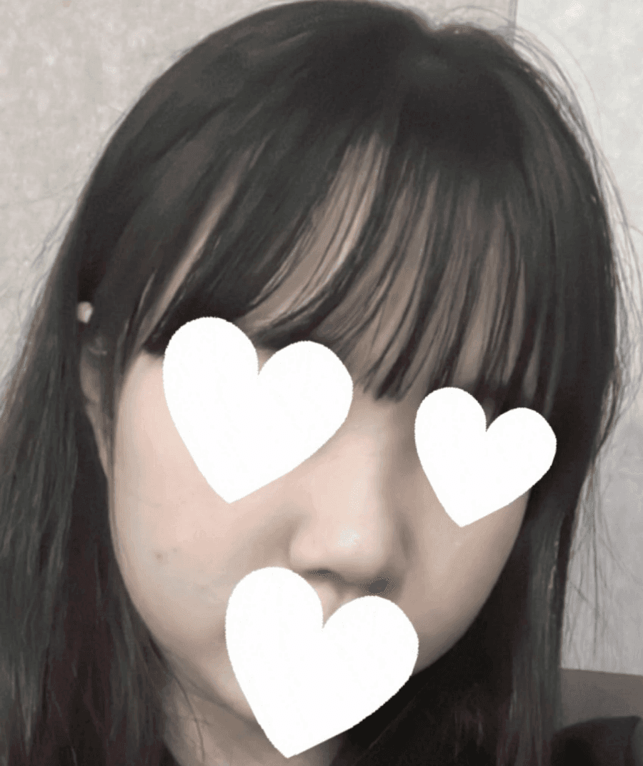 작고 뭉뚝한 코, 비중격만곡증까지 있다면 — 기능코수술을 함께 계획한 사례 관련 이미지 4/17