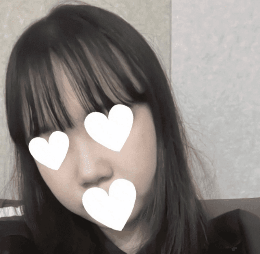 작고 뭉뚝한 코, 비중격만곡증까지 있다면 — 기능코수술을 함께 계획한 사례 관련 이미지 5/17