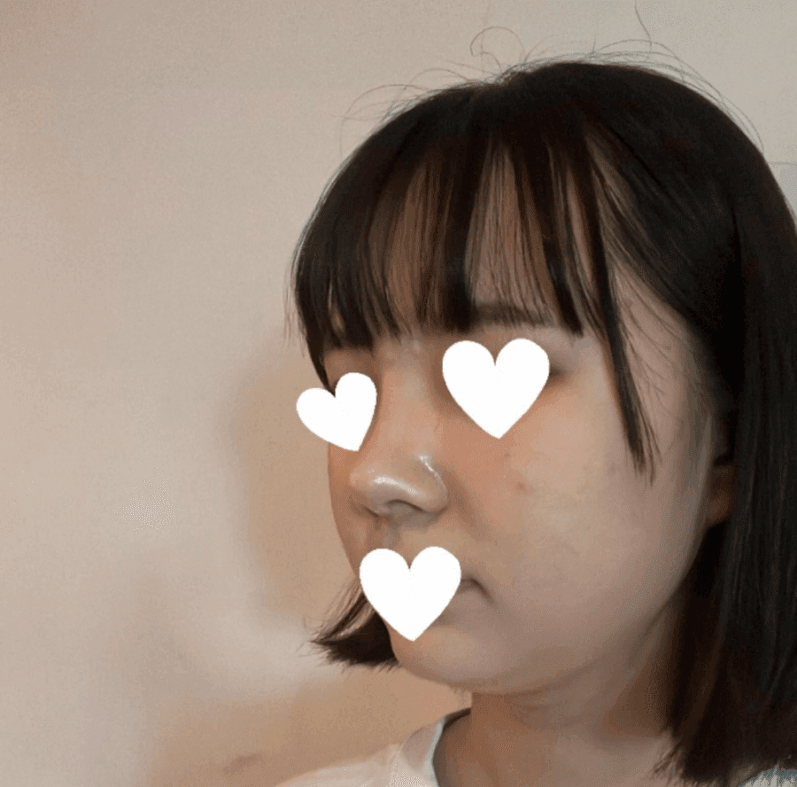 작고 뭉뚝한 코, 비중격만곡증까지 있다면 — 기능코수술을 함께 계획한 사례 관련 이미지 6/17