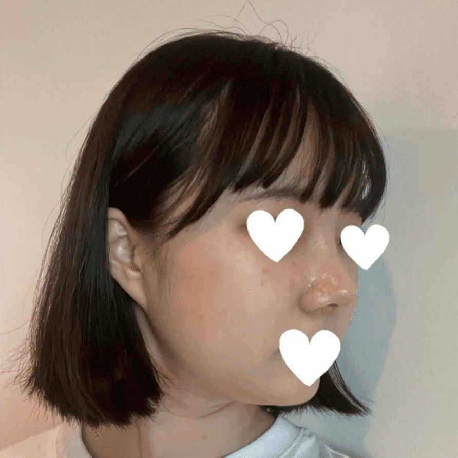 작고 뭉뚝한 코, 비중격만곡증까지 있다면 — 기능코수술을 함께 계획한 사례 관련 이미지 7/17