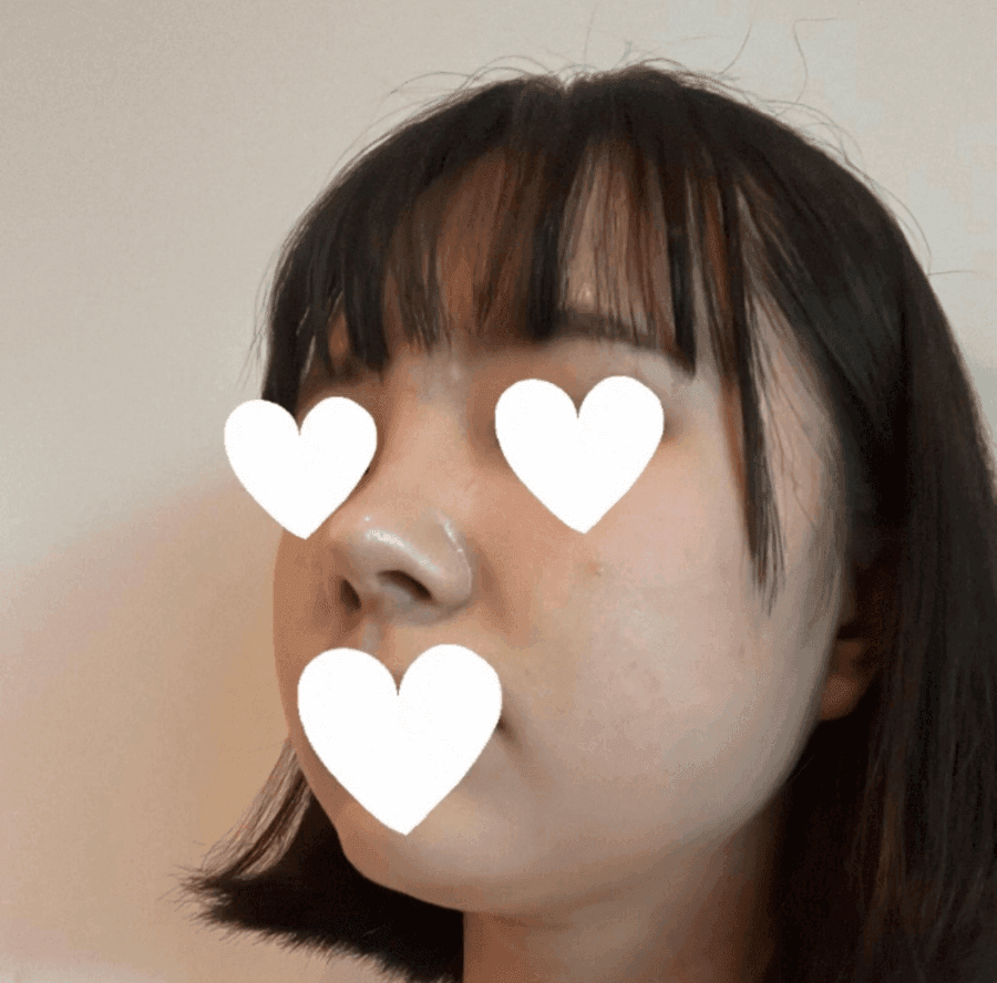 작고 뭉뚝한 코, 비중격만곡증까지 있다면 — 기능코수술을 함께 계획한 사례 관련 이미지 9/17