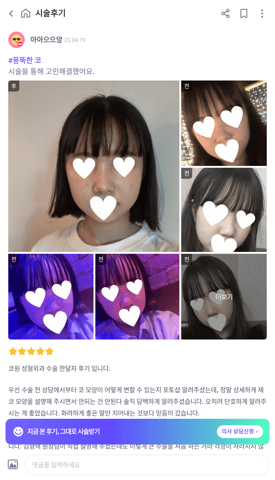 작고 뭉뚝한 코, 비중격만곡증까지 있다면 — 기능코수술을 함께 계획한 사례 관련 이미지 10/17