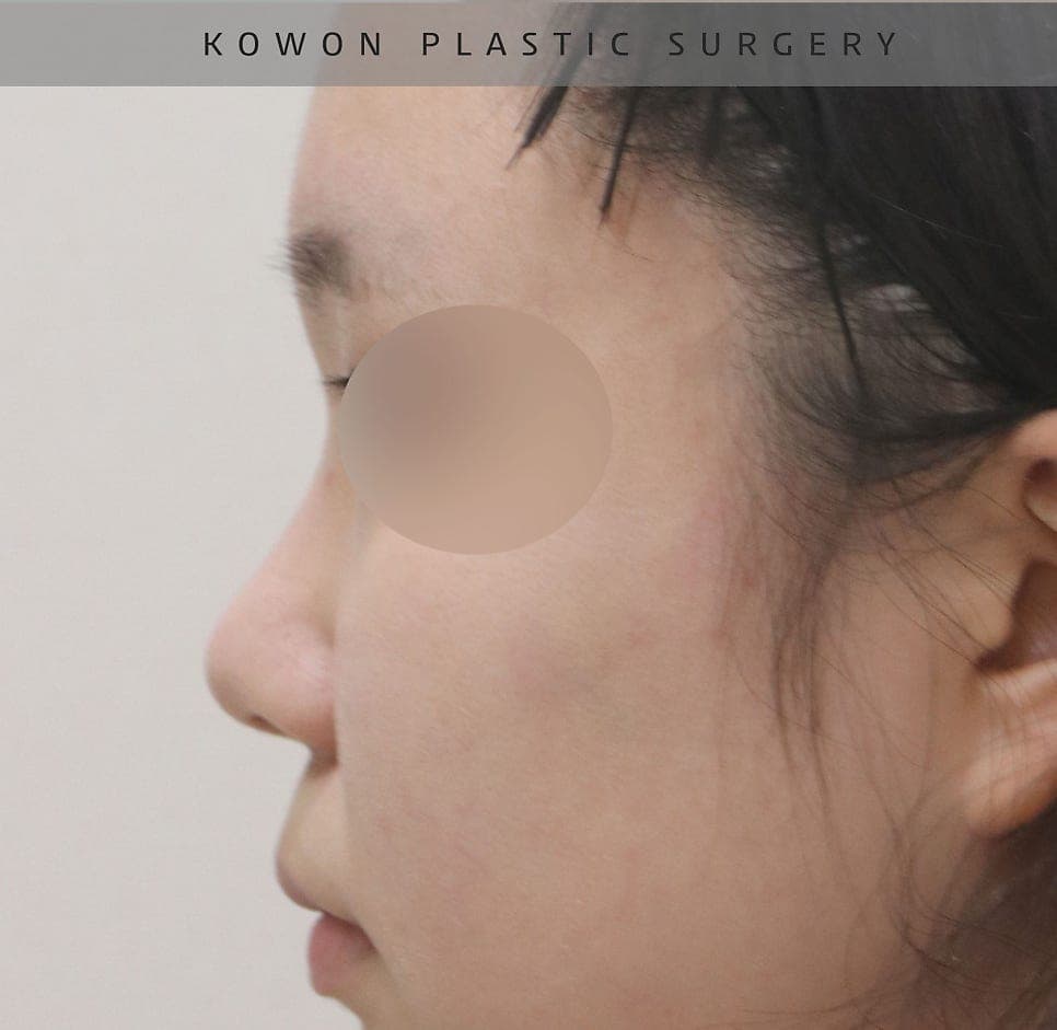 작고 뭉뚝한 코, 비중격만곡증까지 있다면 — 기능코수술을 함께 계획한 사례 관련 이미지 11/17