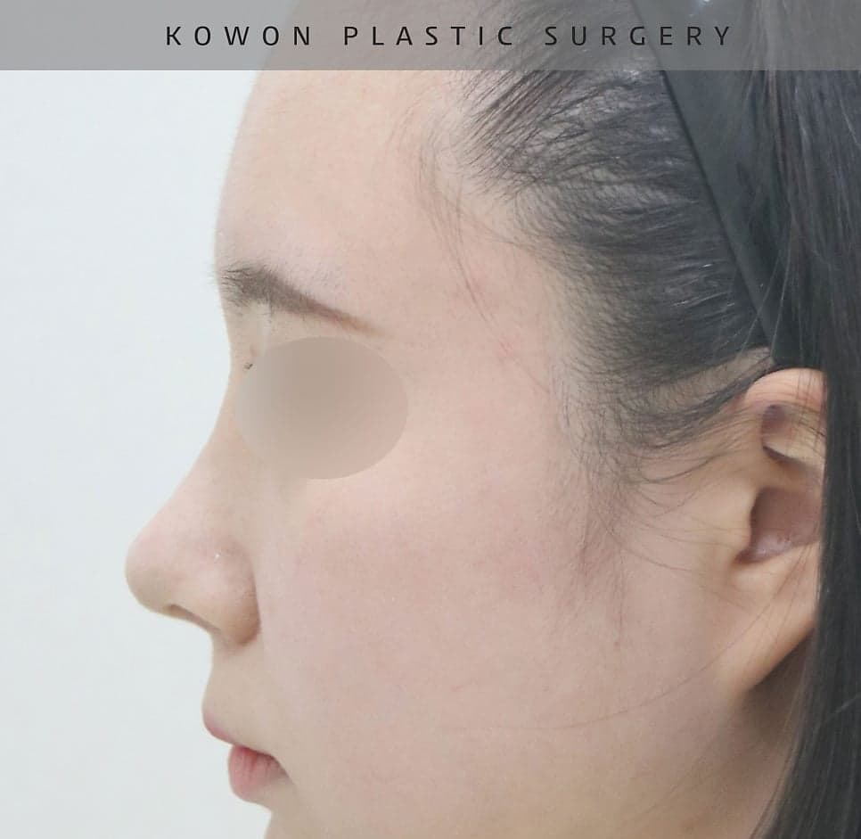 작고 뭉뚝한 코, 비중격만곡증까지 있다면 — 기능코수술을 함께 계획한 사례 관련 이미지 12/17
