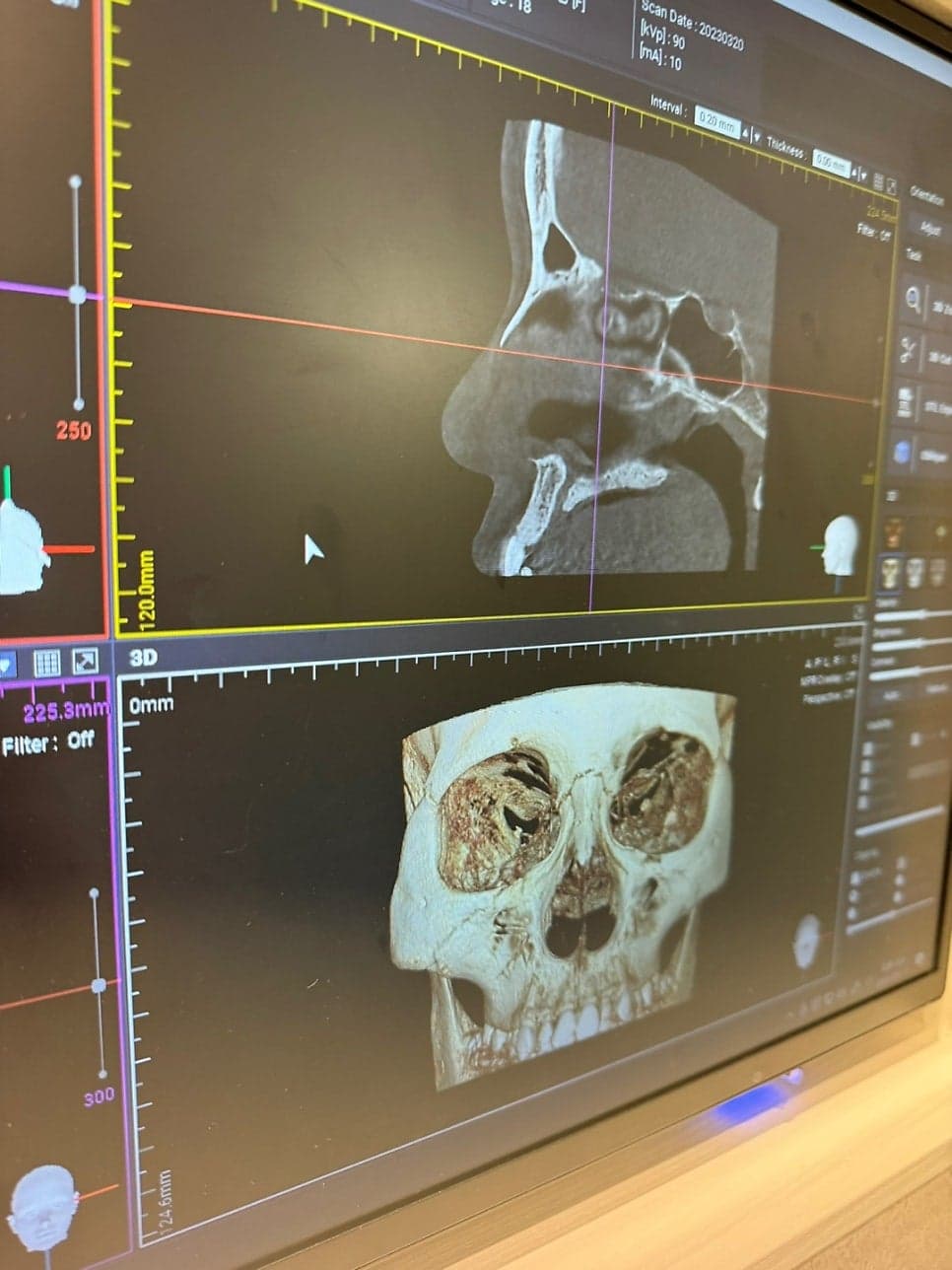 작고 뭉뚝한 코, 비중격만곡증까지 있다면 — 기능코수술을 함께 계획한 사례 관련 이미지 14/17