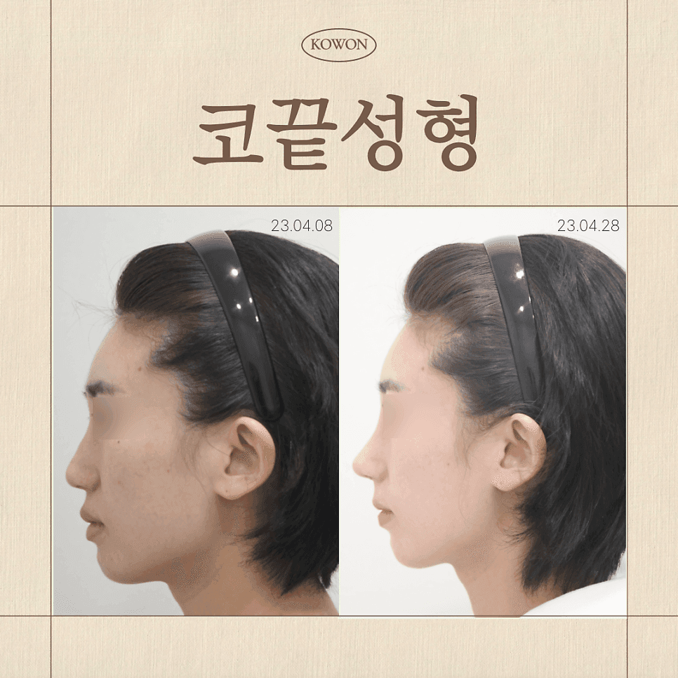 뭉툭한 코 코끝성형, 왜 '끝'만 보면 안 될까요? — 범위·재료·병원 선택 기준 관련 이미지 1/8