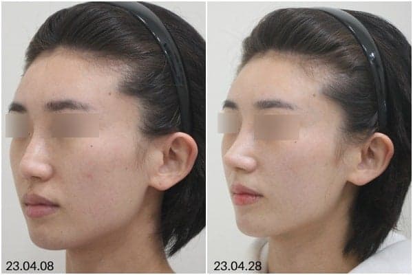 뭉툭한 코 코끝성형, 왜 '끝'만 보면 안 될까요? — 범위·재료·병원 선택 기준 관련 이미지 2/8