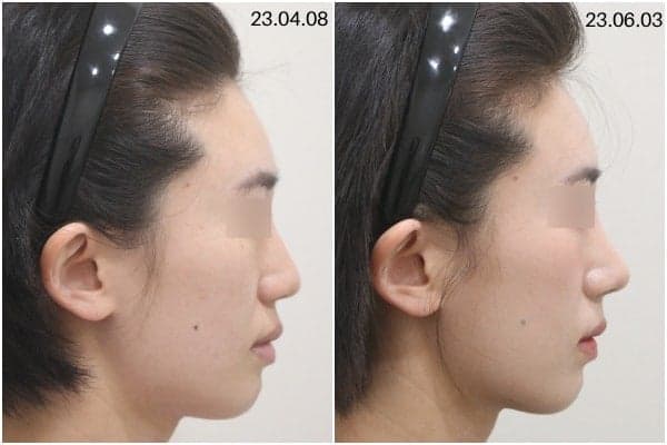 뭉툭한 코 코끝성형, 왜 '끝'만 보면 안 될까요? — 범위·재료·병원 선택 기준 관련 이미지 5/8