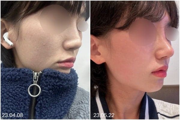 뭉툭한 코 코끝성형, 왜 '끝'만 보면 안 될까요? — 범위·재료·병원 선택 기준 관련 이미지 8/8