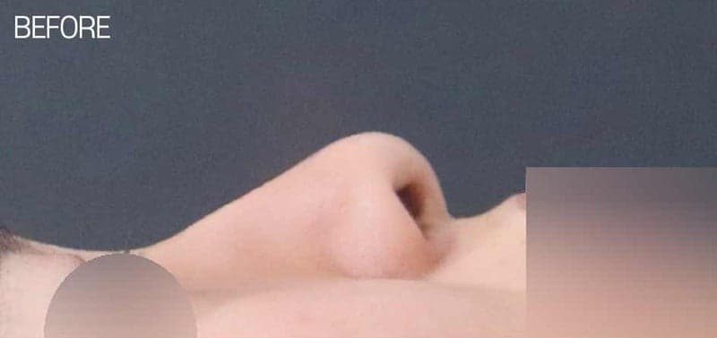 복코성형과 콧볼축소, 돌출입이 들어가 보이는 효과까지 — 귀연골로 진행한 사례 관련 이미지 4/5