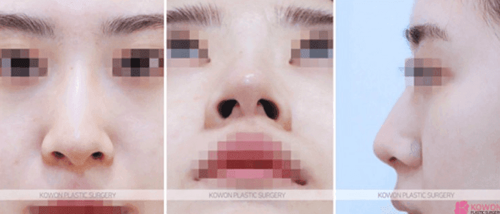 การปรับรูปปลายจมูก ปลายจมูก ปลายจมูกกลมใหญ่บานออกและสันจมูกที่เบี้ยวไปพร้อมกัน — ภาพประกอบเป็นกรณีศึกษาที่ทำโดยไม่ใช้อิมแพลนต์ 4/11