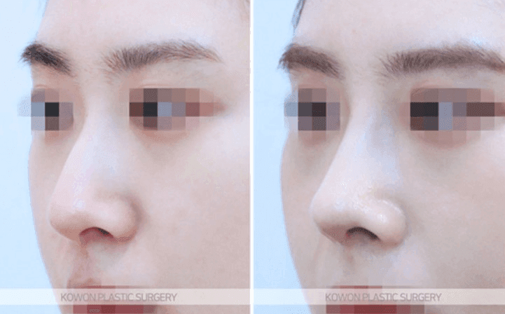 การปรับรูปปลายจมูก ปลายจมูก ปลายจมูกกลมใหญ่บานออกและสันจมูกที่เบี้ยวไปพร้อมกัน — ภาพประกอบเป็นกรณีศึกษาที่ทำโดยไม่ใช้อิมแพลนต์ 6/11