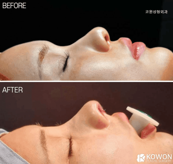 복코수술, 코끝만 줄이면 될까요 — 미간에서 콧대로 이어지는 흐름을 함께 보는 이유 관련 이미지 2/5