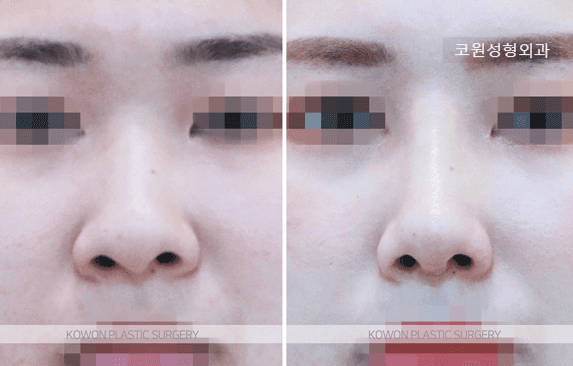 복코수술, 코끝만 줄이면 될까요 — 미간에서 콧대로 이어지는 흐름을 함께 보는 이유 관련 이미지 3/5