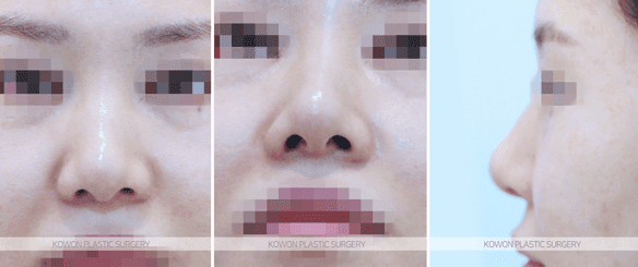 복코수술 전후 변화 — 코끝 구조 정리 과정과 "얼마나 작아질 수 있나"의 현실적 기준 관련 이미지 5/10