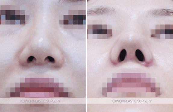 복코수술 전후 변화 — 코끝 구조 정리 과정과 "얼마나 작아질 수 있나"의 현실적 기준 관련 이미지 7/10