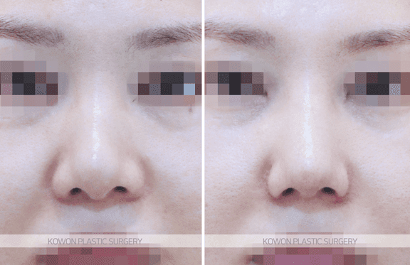 복코수술 전후 변화 — 코끝 구조 정리 과정과 "얼마나 작아질 수 있나"의 현실적 기준 관련 이미지 8/10