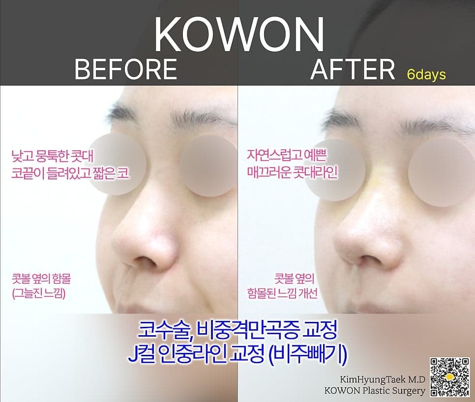 Image 4/6 for ear cartilage grafting and nasolabial angle correction in bulbous rhinoplasty