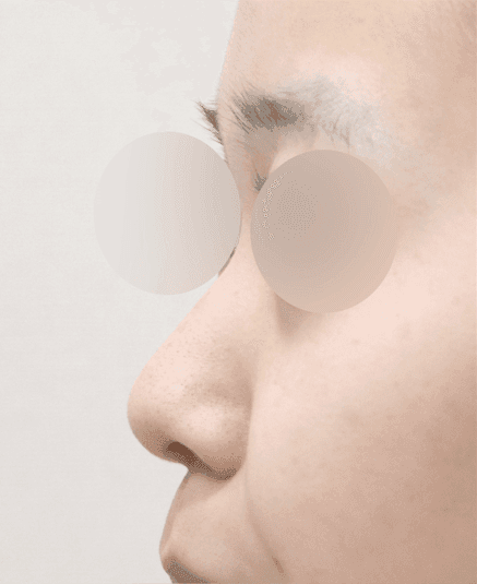 복코성형 귀연골이식과 비순각교정 — 낮은 콧대·함몰된 콧기둥은 어디까지 함께 보나 관련 이미지 5/6