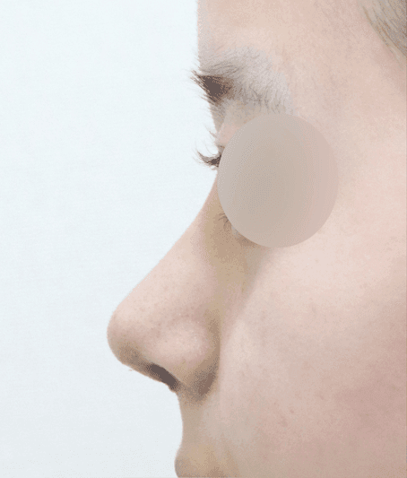 복코성형 귀연골이식과 비순각교정 — 낮은 콧대·함몰된 콧기둥은 어디까지 함께 보나 관련 이미지 6/6