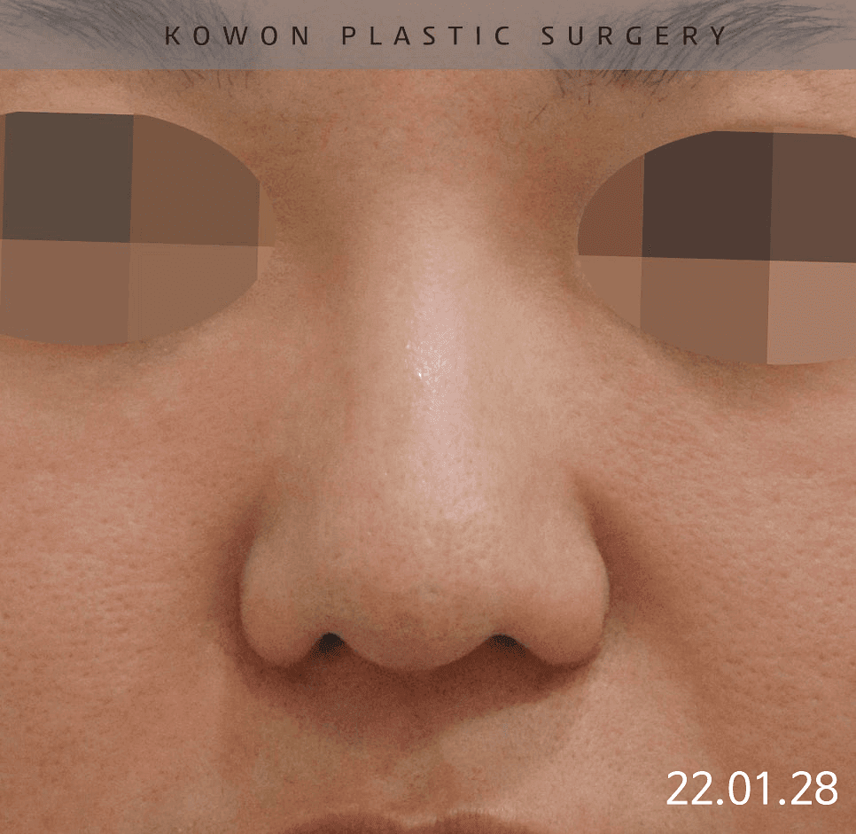 복코성형에서 실패를 줄이려면 — 코끝만 보지 않고 피부·연골·폭까지 확인하는 이유 관련 이미지 2/12