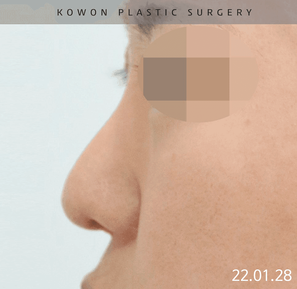 복코성형에서 실패를 줄이려면 — 코끝만 보지 않고 피부·연골·폭까지 확인하는 이유 관련 이미지 3/12