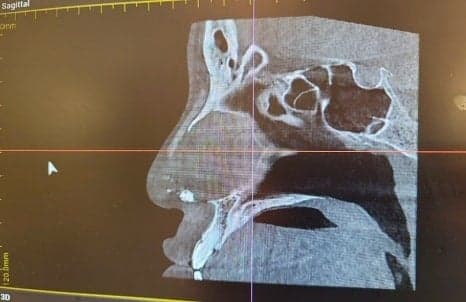 복코성형에서 실패를 줄이려면 — 코끝만 보지 않고 피부·연골·폭까지 확인하는 이유 관련 이미지 5/12