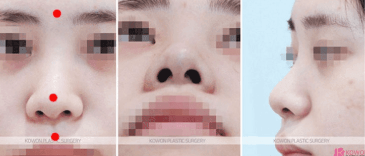 การผ่าตัดปลายจมูกกลมใหญ่สามารถทำได้โดยไม่ใช้อิมแพลนต์? — เกณฑ์ในการพิจารณาการลดปีกจมูกและการต่อผนังกั้นช่องจมูกภาพที่ 3/9