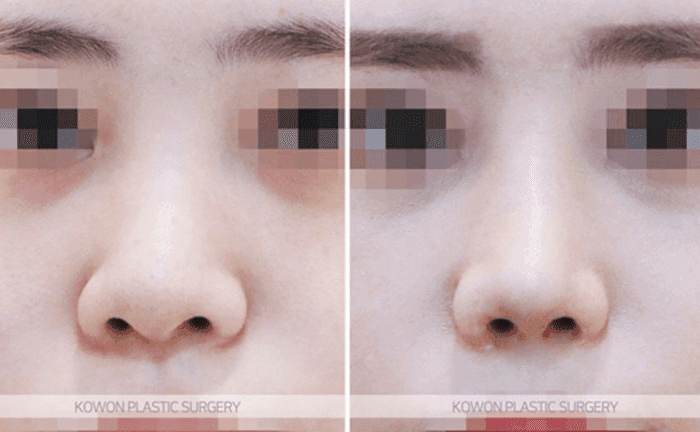การผ่าตัดปลายจมูกกลมใหญ่สามารถทำได้โดยไม่ใช้อิมแพลนต์? — เกณฑ์ในการพิจารณาการลดปีกจมูกและการต่อผนังกั้นช่องจมูกภาพที่ 6/9