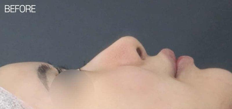 Image 4/5 for why bulbous nose surgery also corrects the nasolabial angle — a thick-nose surgical plan