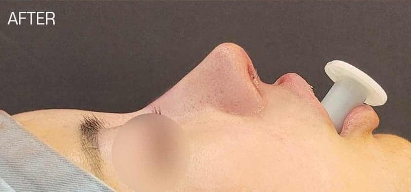 Image 5/5 for why bulbous nose surgery also corrects the nasolabial angle — a thick-nose surgical plan