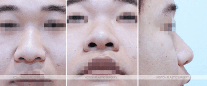 주먹코 수술은 언제 자연스러워지나요 — 직후 변화와 회복기간의 흐름 관련 이미지 4/9