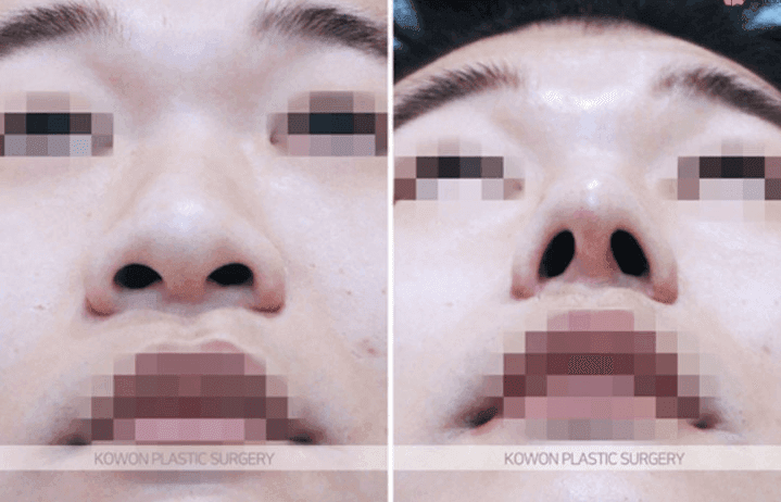 주먹코 수술은 언제 자연스러워지나요 — 직후 변화와 회복기간의 흐름 관련 이미지 5/9