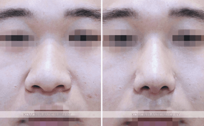 주먹코 수술은 언제 자연스러워지나요 — 직후 변화와 회복기간의 흐름 관련 이미지 6/9
