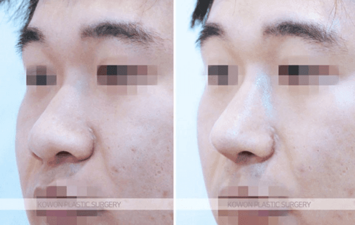 주먹코 수술은 언제 자연스러워지나요 — 직후 변화와 회복기간의 흐름 관련 이미지 7/9