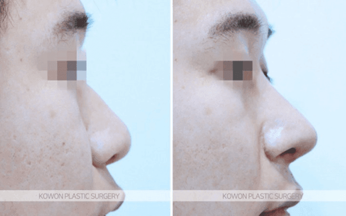 주먹코 수술은 언제 자연스러워지나요 — 직후 변화와 회복기간의 흐름 관련 이미지 8/9